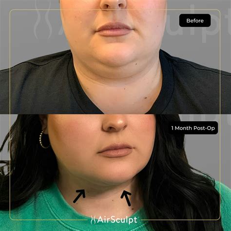 cost airsculpt|Airsculpt Cost 2024: Total Prices Range and Arms, Chin, and。